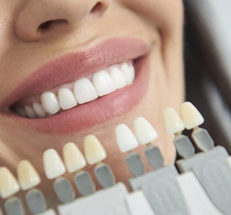Blanqueamiento Dental