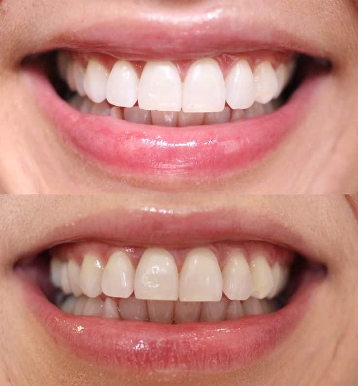 Blanqueamiento Dental